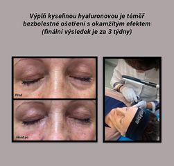 Kyselina hyaluronová - L centrum Pardubice