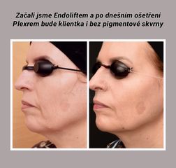 Injekční výplně - L centrum Pardubice