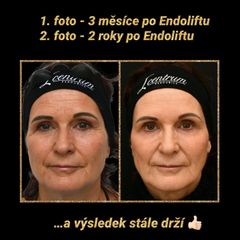Injekční výplně - L centrum Pardubice