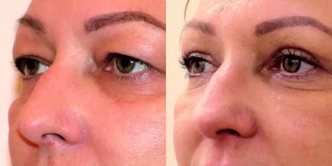 Operace očních víček