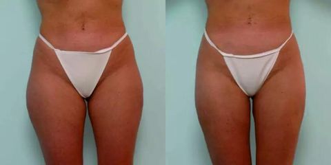 Liposukce nohou