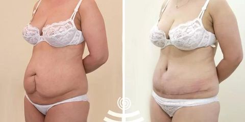 BEFORE abdominoplastika