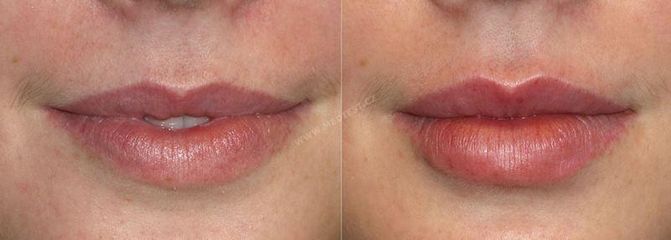 Dermální výplně rtů (2)