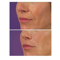 Dermální výplně rtů (7)