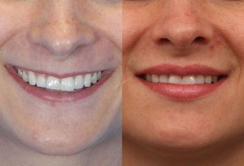 Dermální výplně rtů (1)