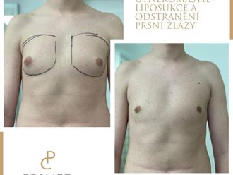 Gynekomastie před a po - 858913