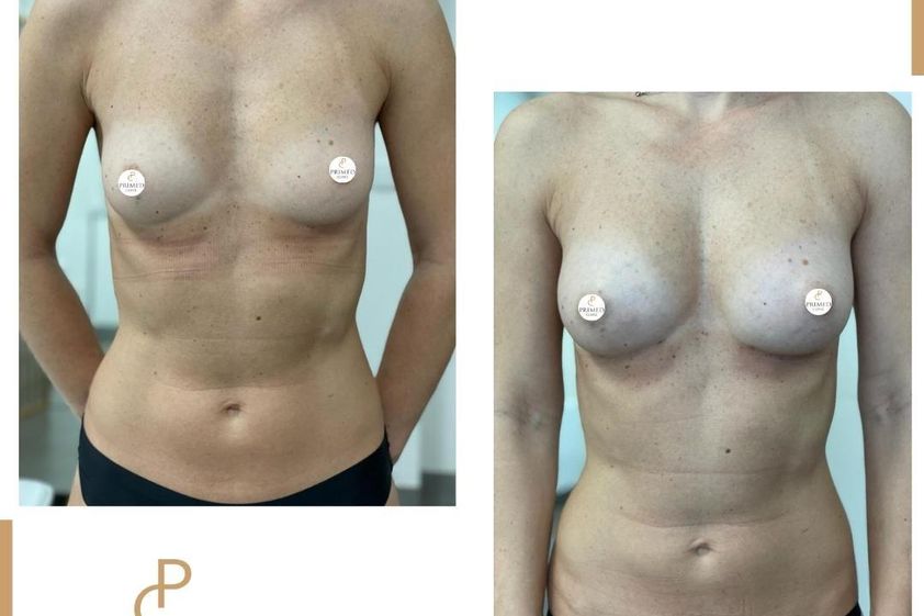 Lipofilling prsou před a po - 858914