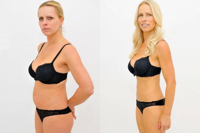 Neinvazivní liposukce před a po - 726643