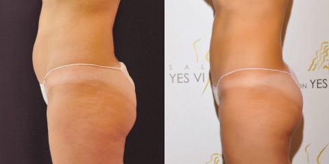 Liposukce