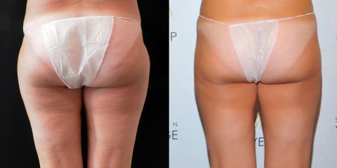 Liposukce