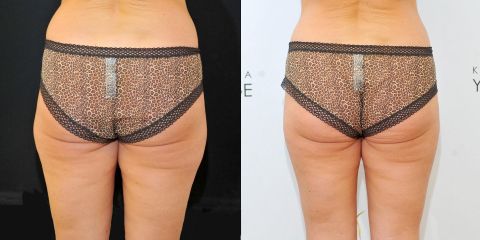 BEFORE lipo2