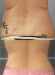 Ferra laserova lipo