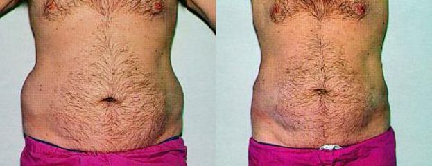 Liposukce - Asklepion