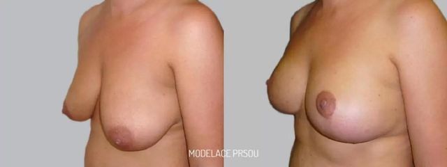 Modelace prsou - Asklepion