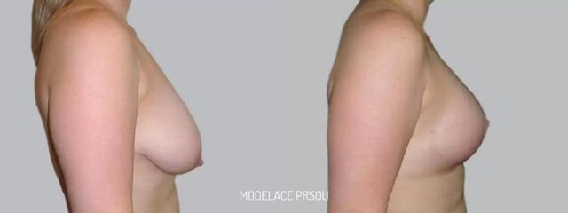 Modelace prsou - Asklepion