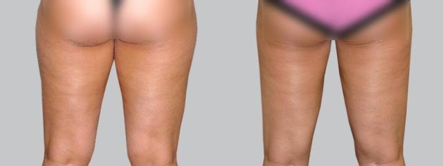 Liposukce - Asklepion