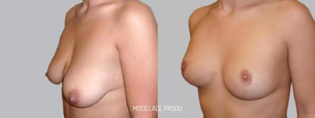 Modelace prsou - Asklepion