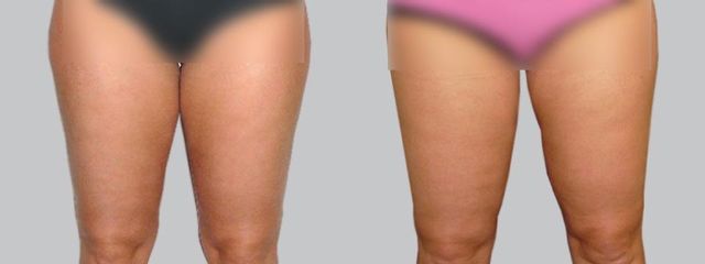 Liposukce - Asklepion