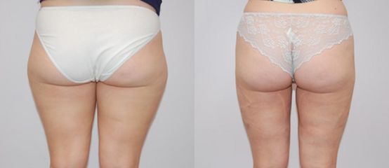 Radiofrekvenční liposulce - Asklepion
