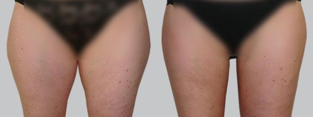 Liposukce - Asklepion