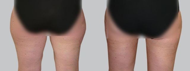 liposukce 2b