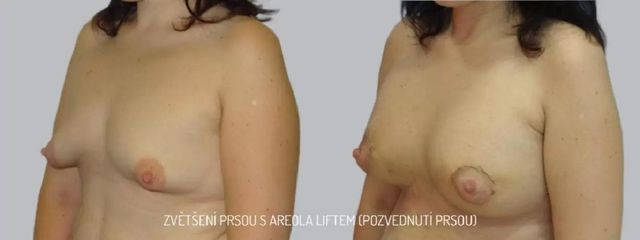 Zvětšení prsou - Asklepion