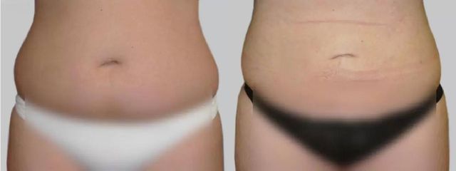 Liposukce - Asklepion