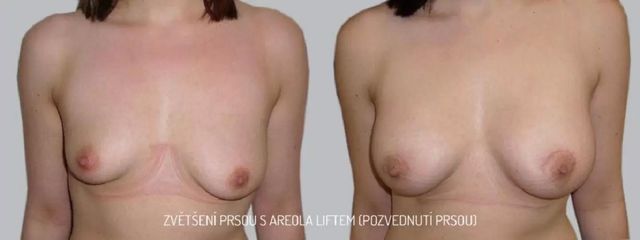 Zvětšení prsou - Asklepion
