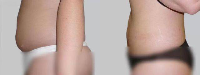 Liposukce - Asklepion