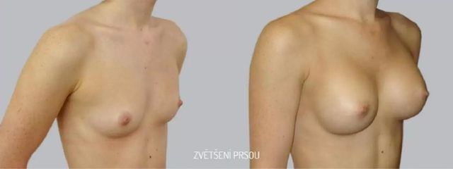Zvětšení prsou - Asklepion