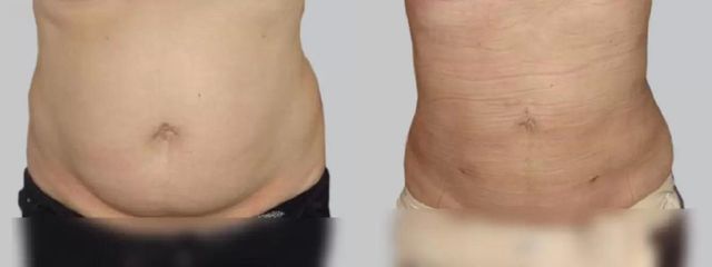 Liposukce - Asklepion