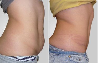 Abdominoplastika - Asklepion