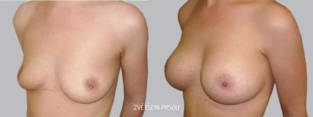 Zvětšení prsou - Asklepion