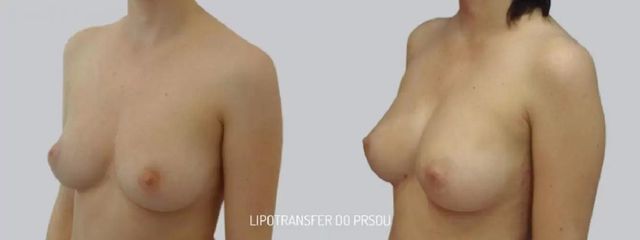 Lipofilling prsou - Asklepion