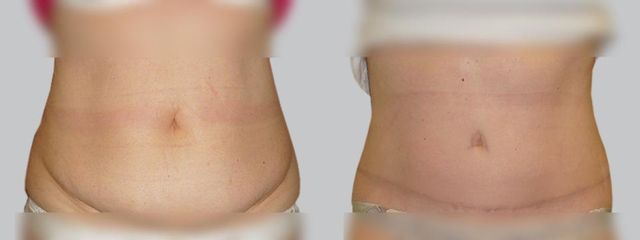 Abdominoplastika - Asklepion