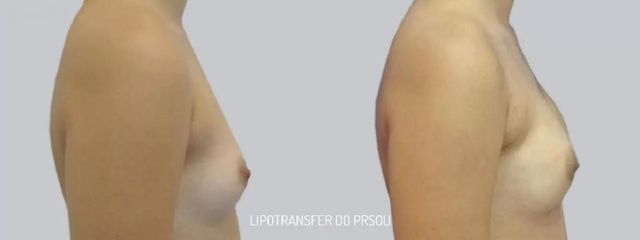 Lipofilling prsou - Asklepion