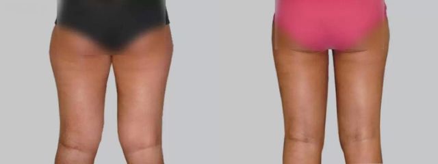 Liposukce - Asklepion