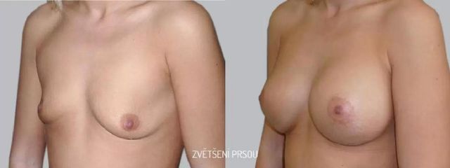 Zvětšení prsou - Asklepion