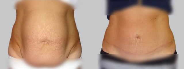 Abdominoplastika - Asklepion