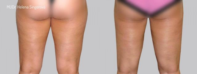 Liposukce - Asklepion