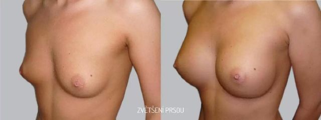 Zvětšení prsou - Asklepion