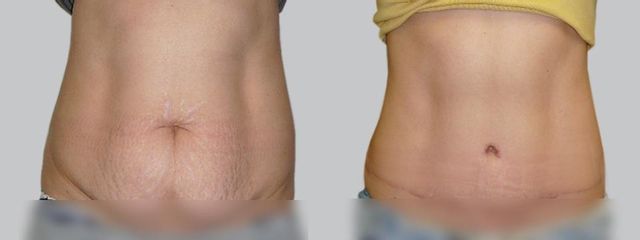 Abdominoplastika - Asklepion