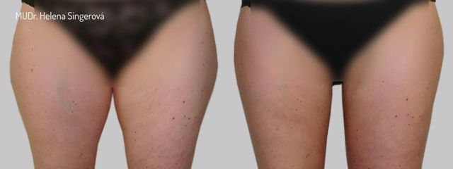 Liposukce - Asklepion