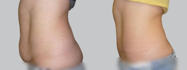 Abdominoplastika - Asklepion