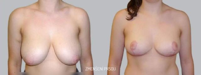 Zmenšení prsou - Asklepion