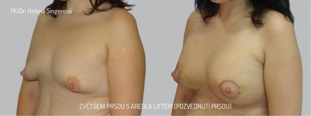 Zvětšení prsou - Asklepion
