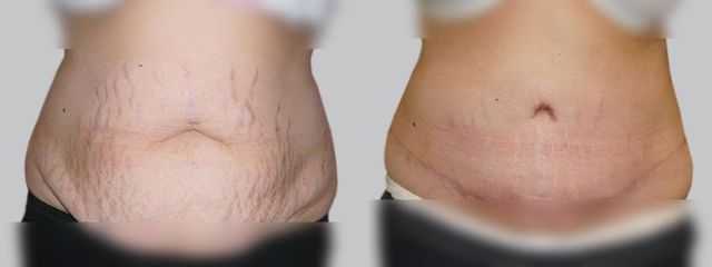 Abdominoplastika - Asklepion