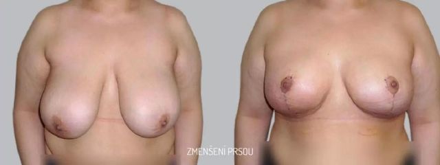 Zmenšení prsou - Asklepion