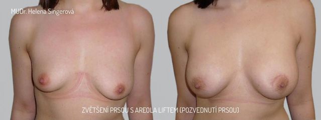 Zvětšení prsou - Asklepion