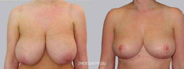 Zmenšení prsou - Asklepion